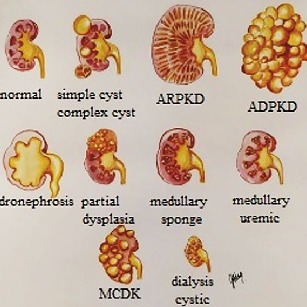 Images Of Renal Cysts