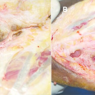 Fig 4. (A) Photograph showing multiple subcutaneous and bone cavities studded with grains at surgery. (B) The same cavities after surgical excisions. doi:10.1371/journal.pntd.0004690.g004  