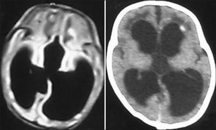 Left Axial T1 Mri Cuts Showing Obstructive Hydrocephalus With Dilated