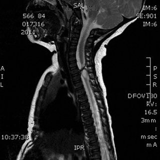 MRI cervico-dorsal spine showing transection of spinal cord in the ...