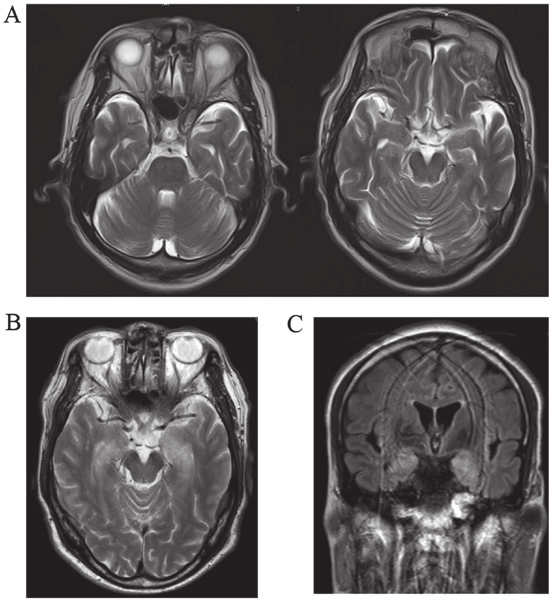 A The Initial Brain Magnetic Resonance Imaging Mri Was Normal B