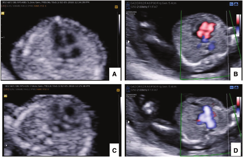 Normal Fetal Echocardiography At 13 Weeks Gestation A Normal
