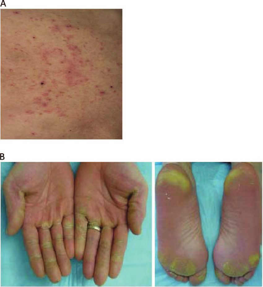 Skin Rashes Include A Erythema Maculopapular Dermatitis Or