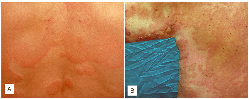 Clinical Pictures Of Chronic Urticaria And Bullous Pemphigoid Wheals