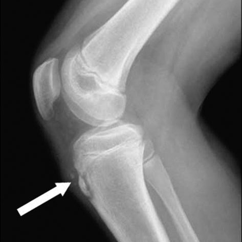 Lateral Radiograph Of The Knee Shows Soft Tissue Swelling And