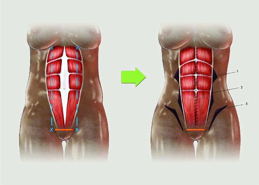 Markings For Muscular Plication As The Rectus Abdominis Muscle