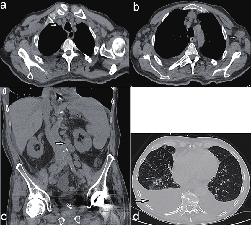 A Ct Scan Of The Chest Showing Mediastinal Lymphadenopathy Arrow