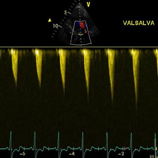 LVOT gradient in HOCM – Doppler echocardiogram – All About