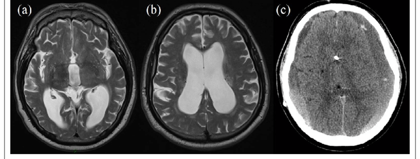 Figure 4 Mri Scan A B Shows Dilated Ventricular System In A Patient