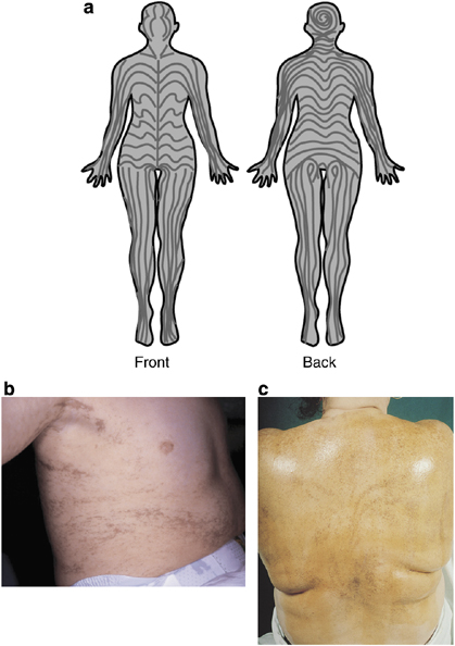 Patterns Of X Linked Skin Disease A Blaschkos Lines The Visual