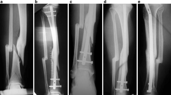 Closed Tibial Fracture At The Site Of A Previous Malunion In A