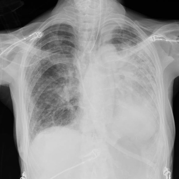 a): Chest X-ray in anteroposterior projection. Ground-glass multilobar ...