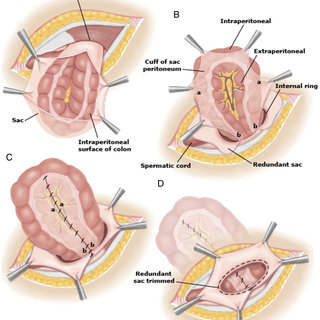 Pdf Does Inguinal Hernia Repair Have An Effect On Sexual Functions