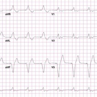 12-lead ECG obtained from a patient with an endocardial LV lead with a... | Download Scientific ...