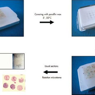 Stepwise construction of a tissue microarray. (A) A paraffin wax core