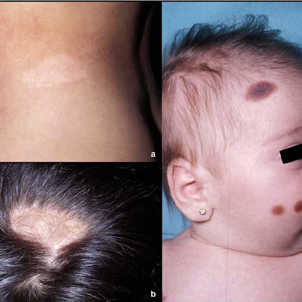 The Patchy Indented Shape A Nevus Depigmentosus B Beckers Nevus