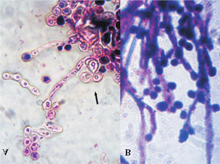 Microscopy of isolated Stephanoascus ciferrii from Sabouraud dextrose ...