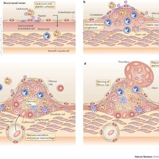 Development progression of atherosclerosis. from et... | Scientific Diagram