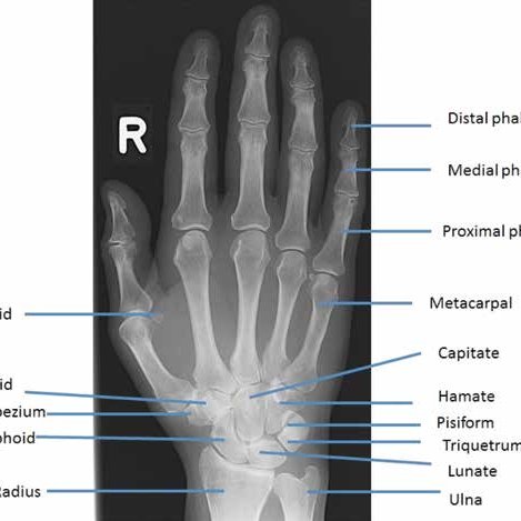 Standard AP X ray of the Hand and wrist with labels naming the bones ...
