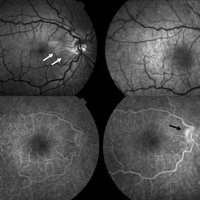 (PDF) Impending central retinal vein occlusion associated with ...