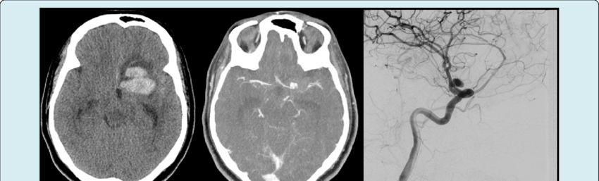 CT Scan (A) shows bleed in the left frontal lobe. Subsequent CTA (B ...
