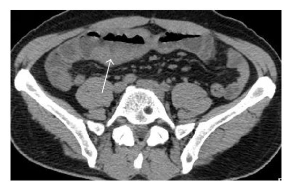 Abdominal Ct Scan In A 48 Year Old Female With Gastric Lymphoma Axial
