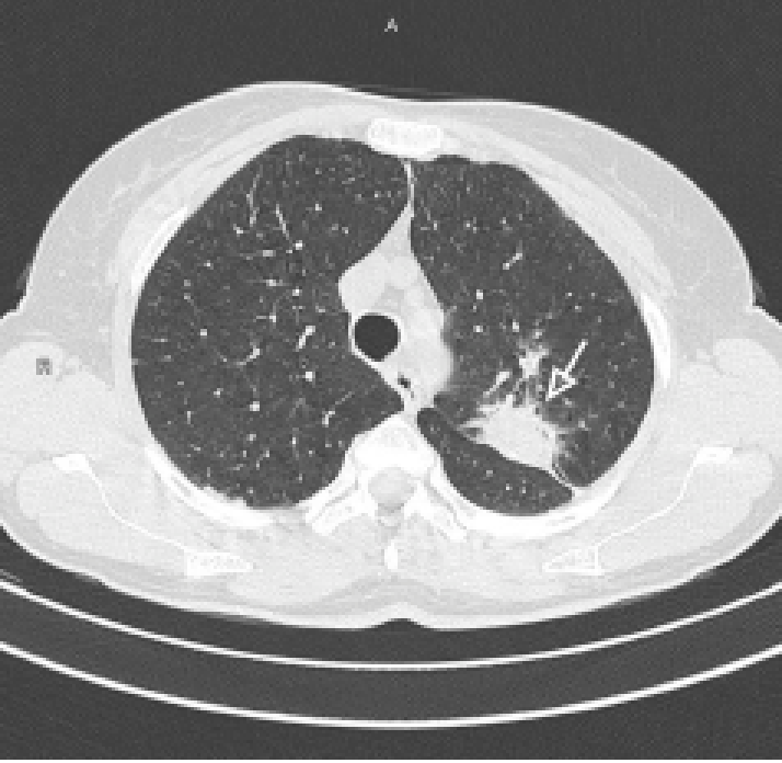 Maging Ct Scan Shows The Left Lung Lesion Characterized By A Solid
