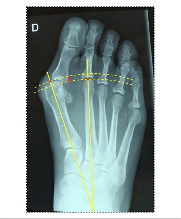 Technique to measure the protrusion between 2 metatarsals. | Download ...