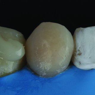 Orthodontic traction of a retained upper canine with Edgewise