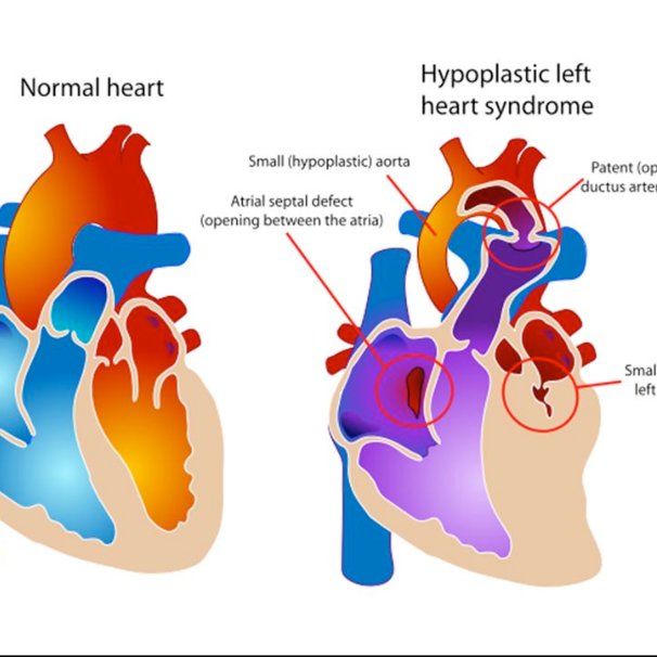 Illustration of a normal heart and a heart with HLHS. In HLHS, blood ...