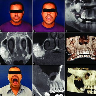 Caso raro de extensa exostose maxilar e mandibular: relato de caso