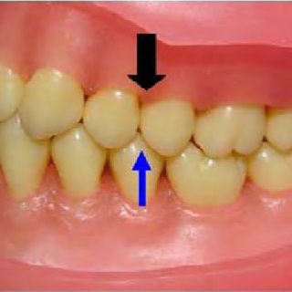 1 -Anatomia do 1º pré-molar inferior (34). A -Face vestibular; B -Face
