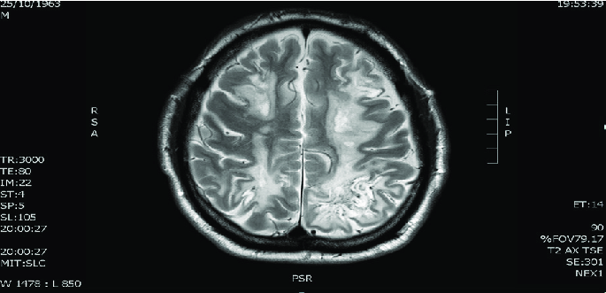 Showing diffuse White matter lesions on MRI of brain (T2 axial