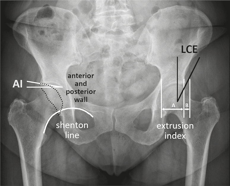 schematic illustration of radiographic hip parameters on an AP pelvic ...