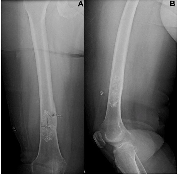 A Ap And Lateral Radiograph Shows A Metastatic Lesion Of The Femoral