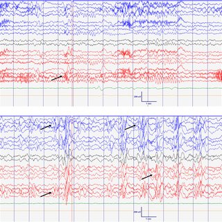 EEG at 8 months old. Normal interictal background activity (5 Hz PDF ...