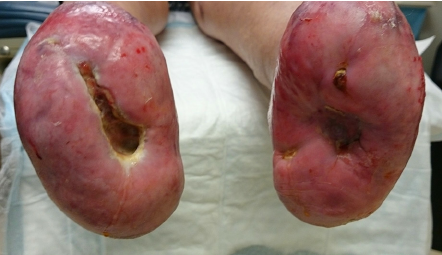 Fig-6-Postoperatively-the-right-wound-dehisced-and-after-repeated-use-of-Santyl-with.png