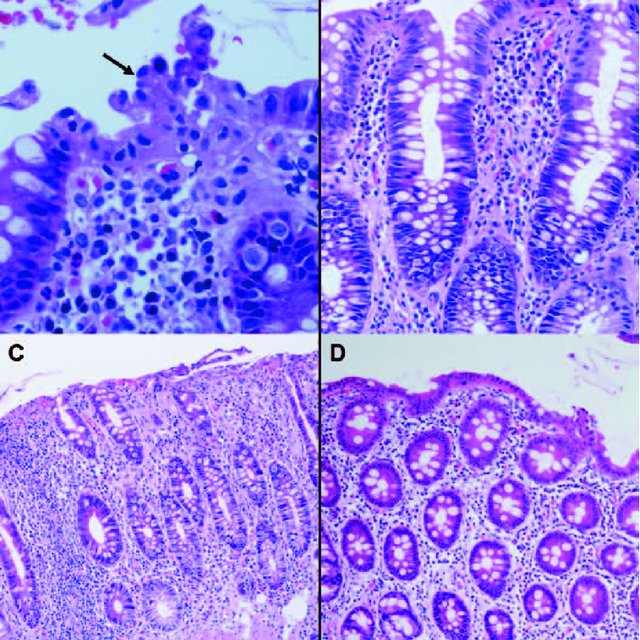 (PDF) Mucosal Inflammation as a Component of Tufting Enteropathy