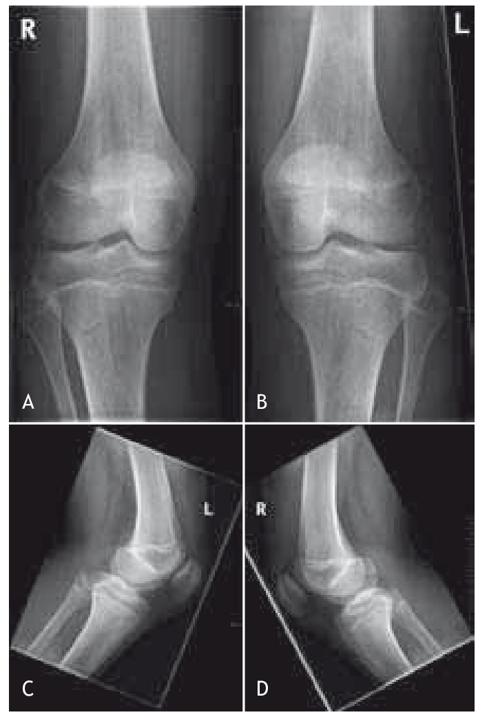 X Rays Of Both Knees Of Our Patient A And B Ap Shot Of The Left And
