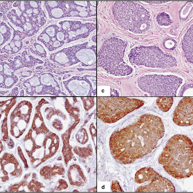 Kit Immunohistochemical Expression In Primary Adenoid Cystic Carcinoma