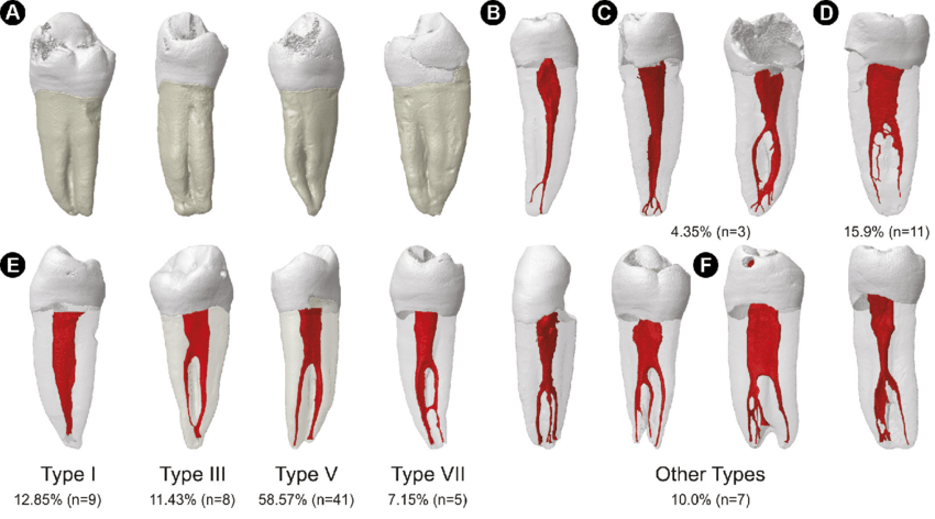 Unusual Root Canal Morphology Of Mandibular Second Premolars A Case ...