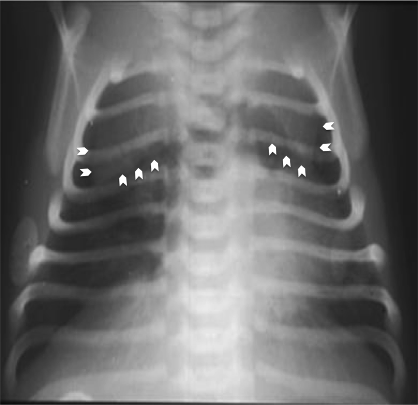 Frontal view x-ray shows a large pneumo-mediastinum elevating thymic