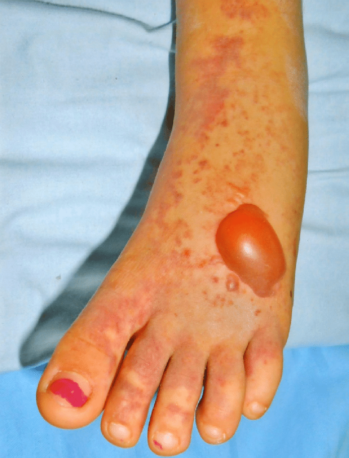 Large 25 Cm Of Diameter Hemorrhagic Bullous Lesion On Left Foot Arch