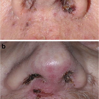 Pdf Nasal Vestibulitis Due To Targeted Therapies In Cancer Patients