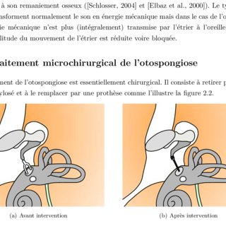 PDF) Conception d'un système robotisé d'aide à la microchirurgie ...