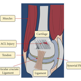The knee bone anatomy and injury mechanism. (a) Structure of knee ACL ...