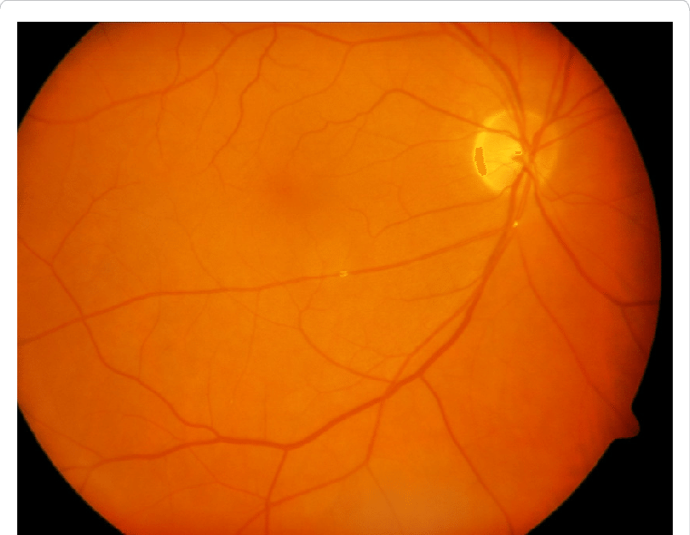 Fundus Photography Of The Right Eye Taken About 2 Weeks After The Acute