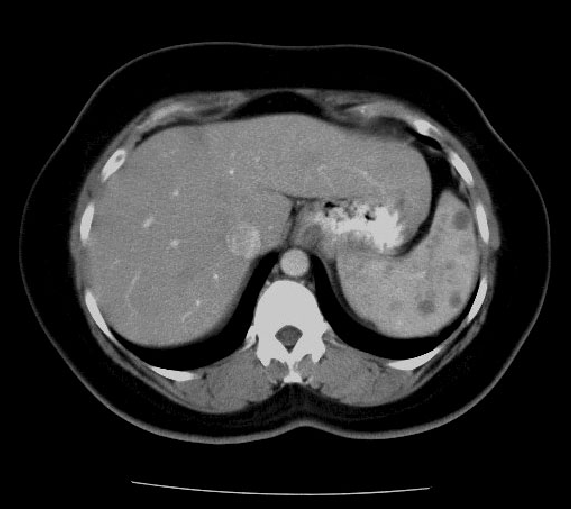 Abdominal Ct Scan Showing Multiple Lesions In The Spleen In A Yr Old ...