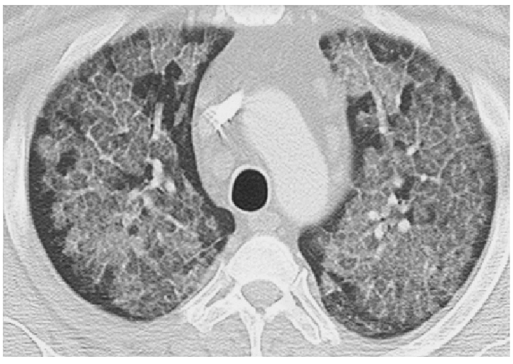 Chest Ct Scan Of A Patient With Pap Revealing Bilateral Alveolar
