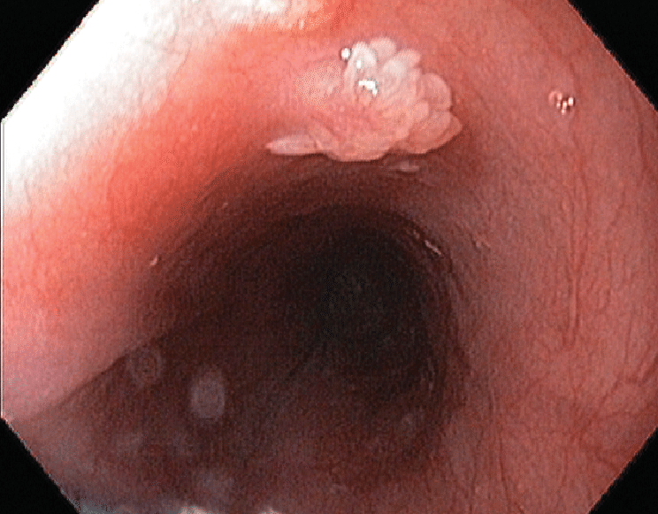 esophageal papilloma endoscopy